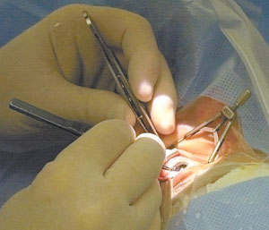 Working carefully, local ophthalmologist Dr. John Wilding prepares to implant a new lens into the eye of a cataract patient. Wilding learned about the Crystalens procedure while attending a national conference in California earlier this year and began performing it locally in July. The new lens has freed patients from needing glasses for most daily activities. Wilding, who has an office in Celina, also does the surgery<br>at Mercer County Community Hospital in Coldwater, Joint Township District Memorial Hospital in St. Marys, and Valley Regional Surgery Center<br>in Piqua.<br>dailystandard.com